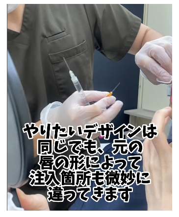 唇へのヒアルロン酸注入のメイン画像