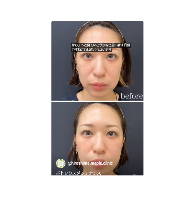 ボトックスのメイン画像