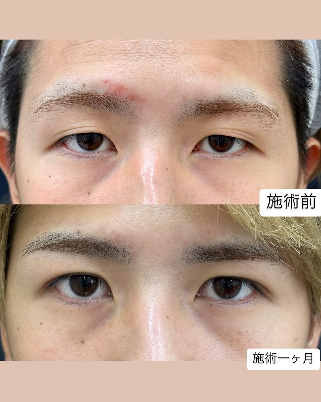 男性向け二重整形埋没法のメイン画像