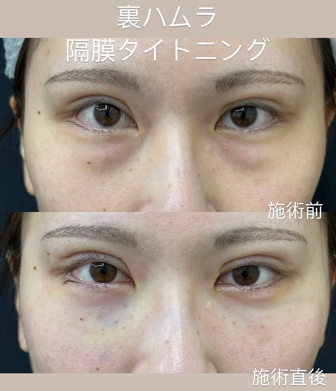 クマ取り治療-裏ハムラ法-のメイン画像