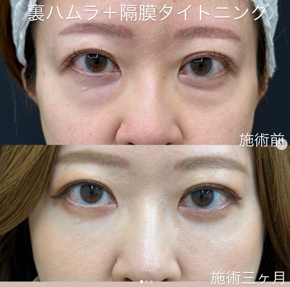 裏ハムラ+隔膜タイトニングのメイン画像