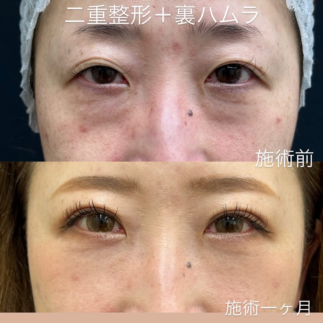 二重整形とクマ取り裏ハムラ法のメイン画像