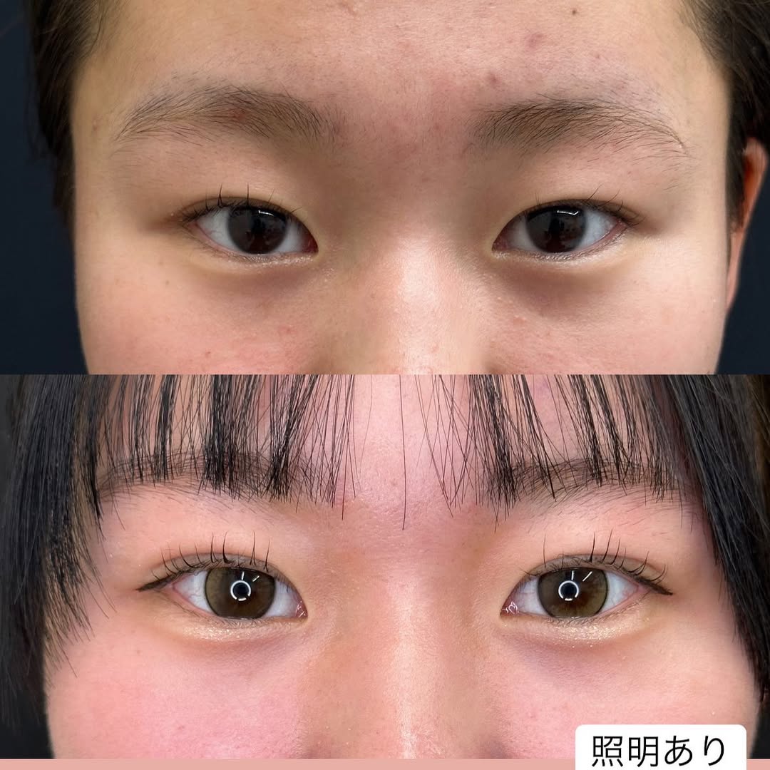 埋没法