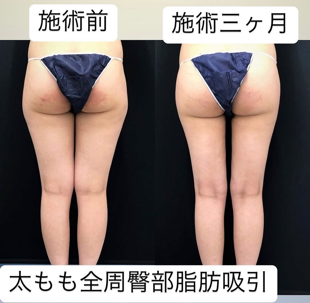 太もも脂肪吸引
