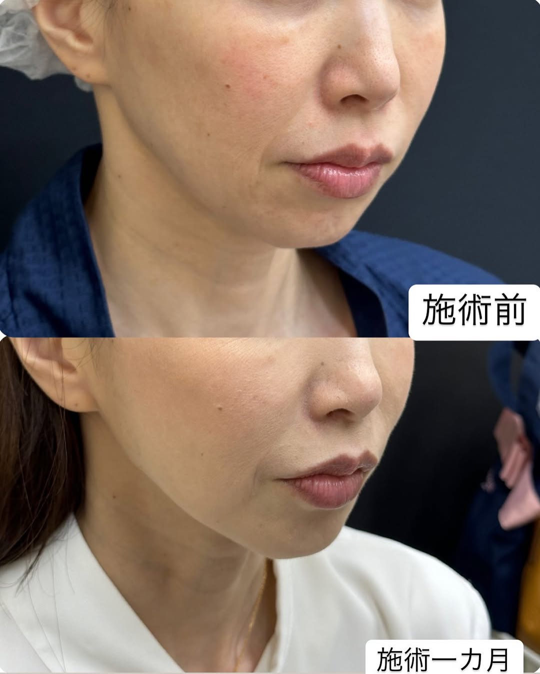 糸リフト