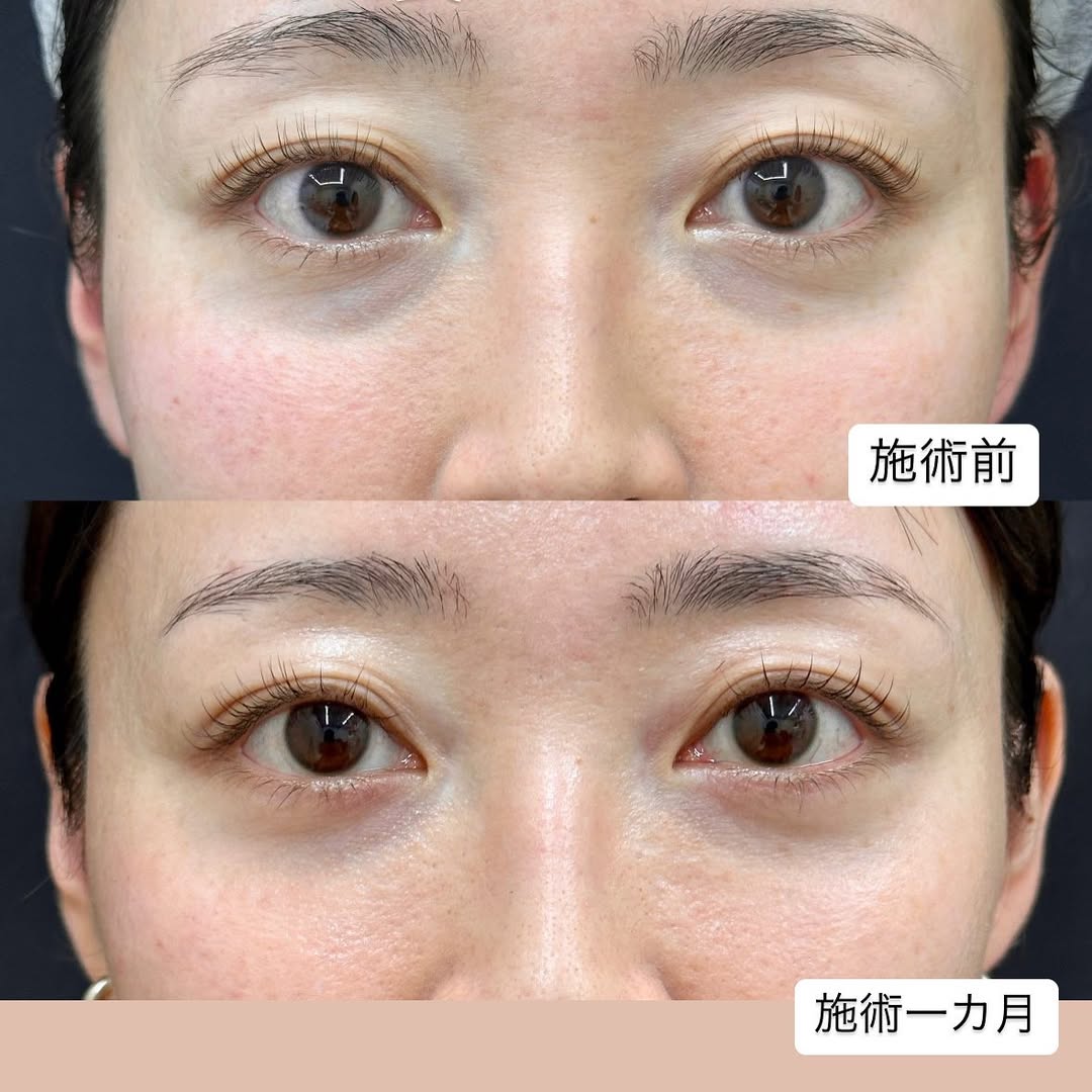クマ取りの症例のメイン画像