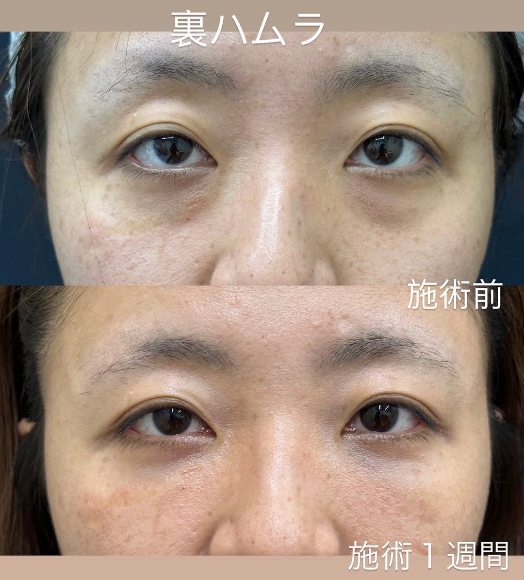 若返りはクマ取り治療がおすすめですのメイン画像