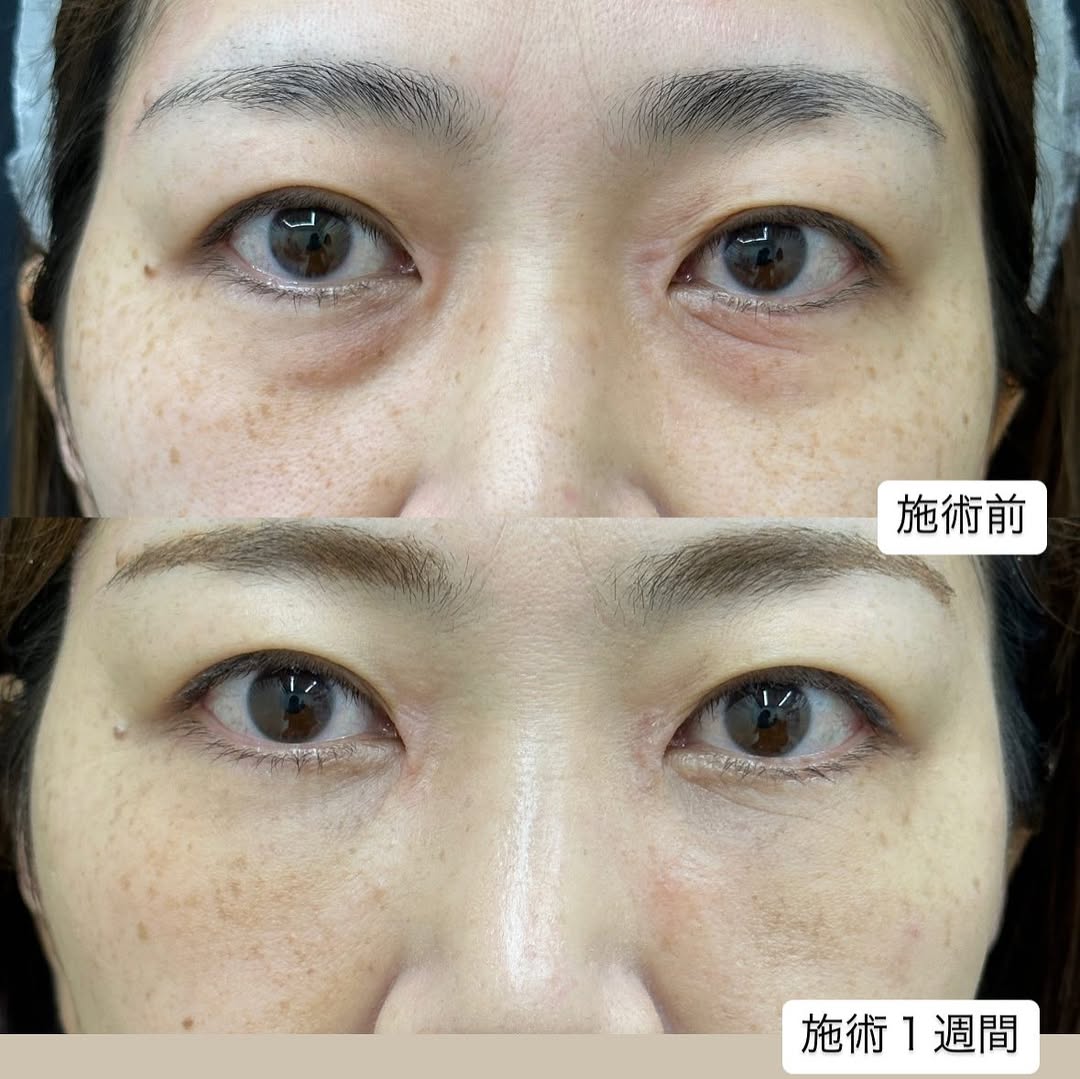 裏ハムラ法施術1週間のメイン画像