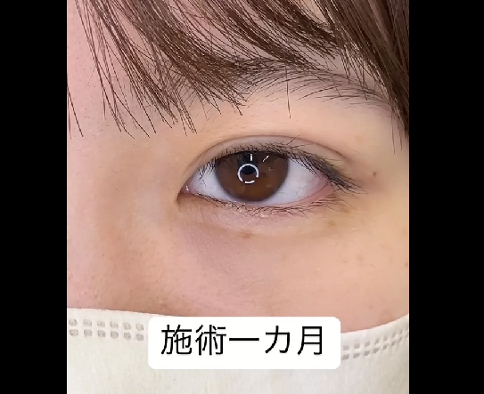 二重整形埋没法-術後1か月-のメイン画像