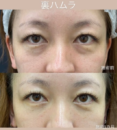 裏ハムラ法
