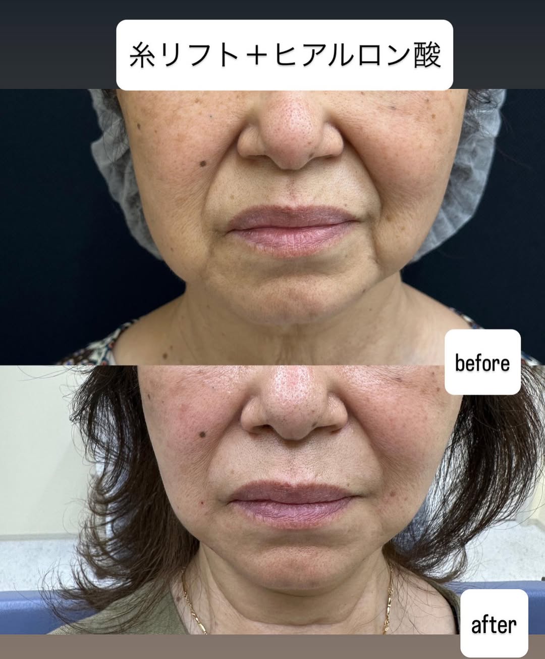 糸リフト