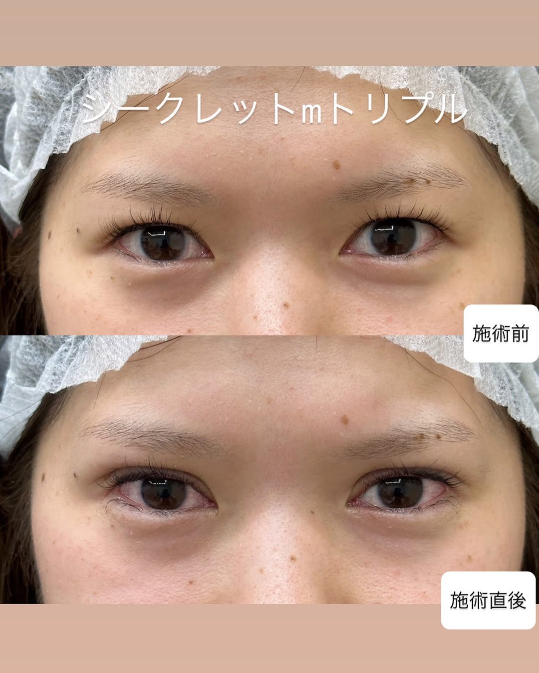 埋没法 シークレットMトリプルのメイン画像