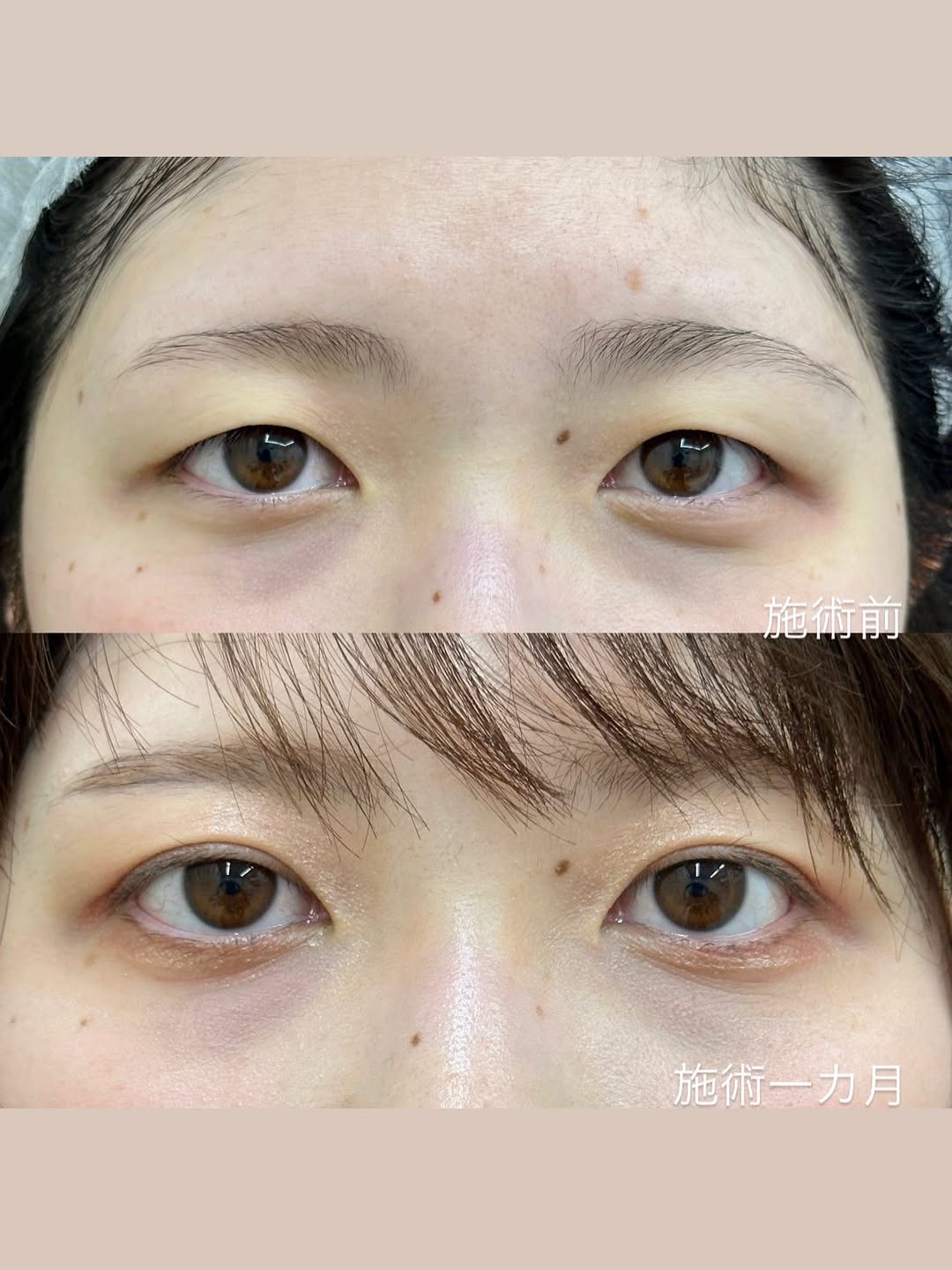 埋没法 シークレットmダブルの症例のメイン画像