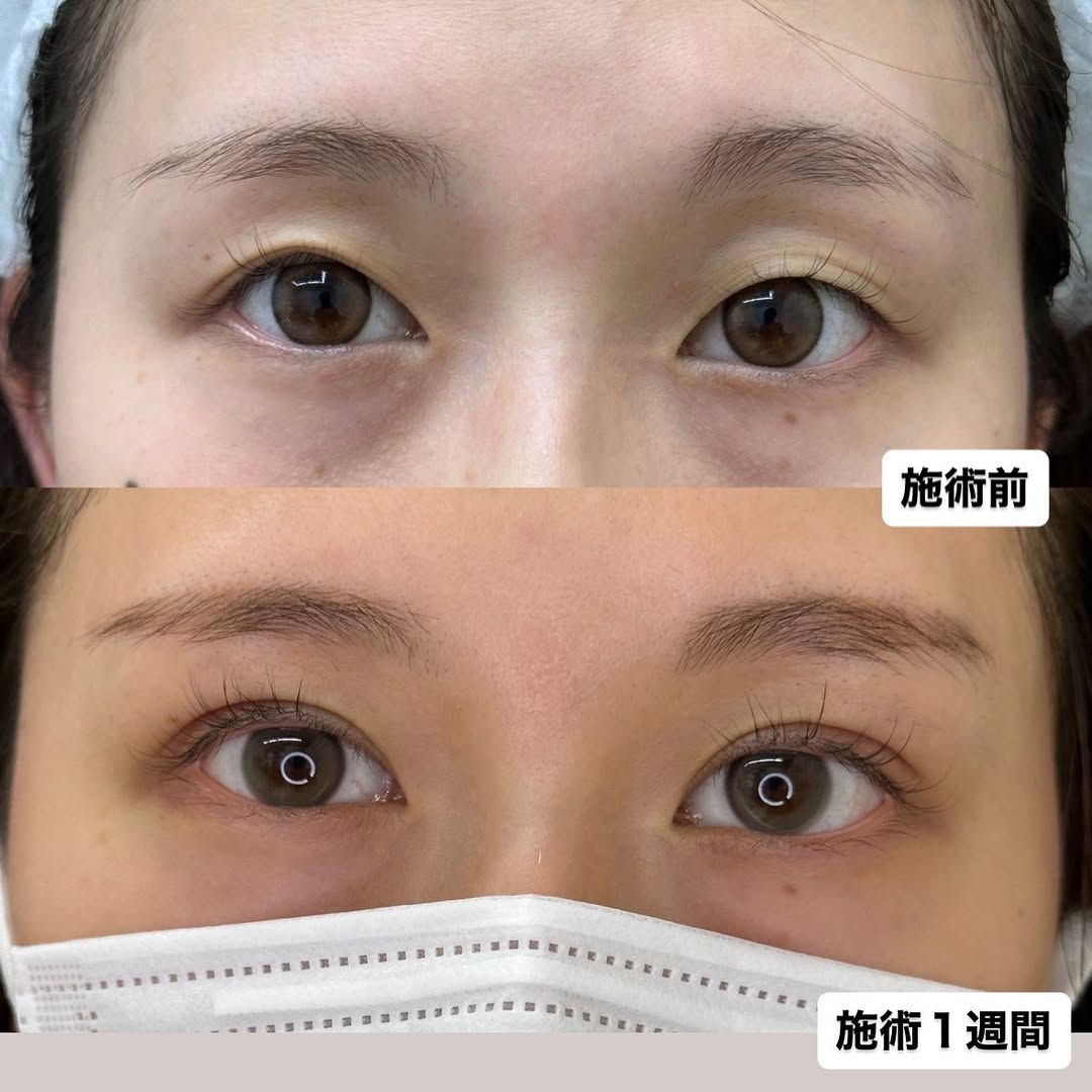 二重整形埋没法-シークレットMダブル-のメイン画像