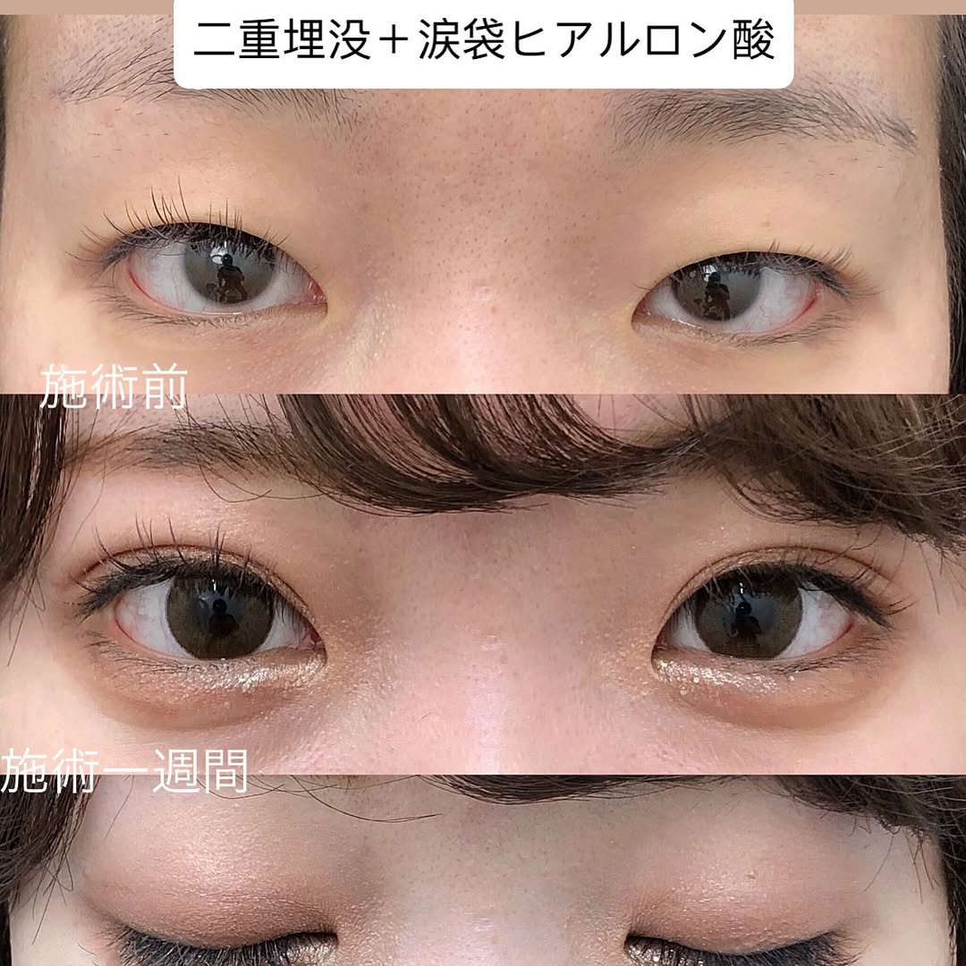 二重埋没法＋涙袋ヒアルロン酸のメイン画像