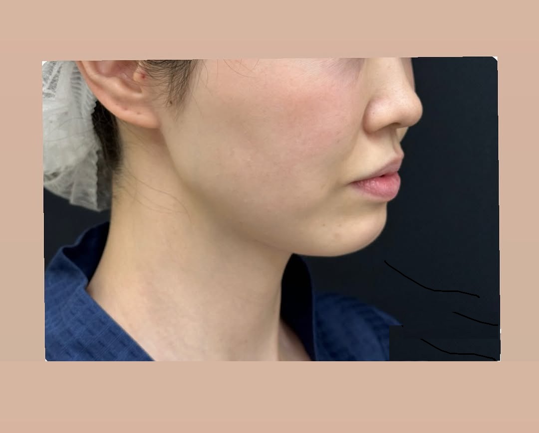 脂肪吸引と糸リフトの症例のメイン画像