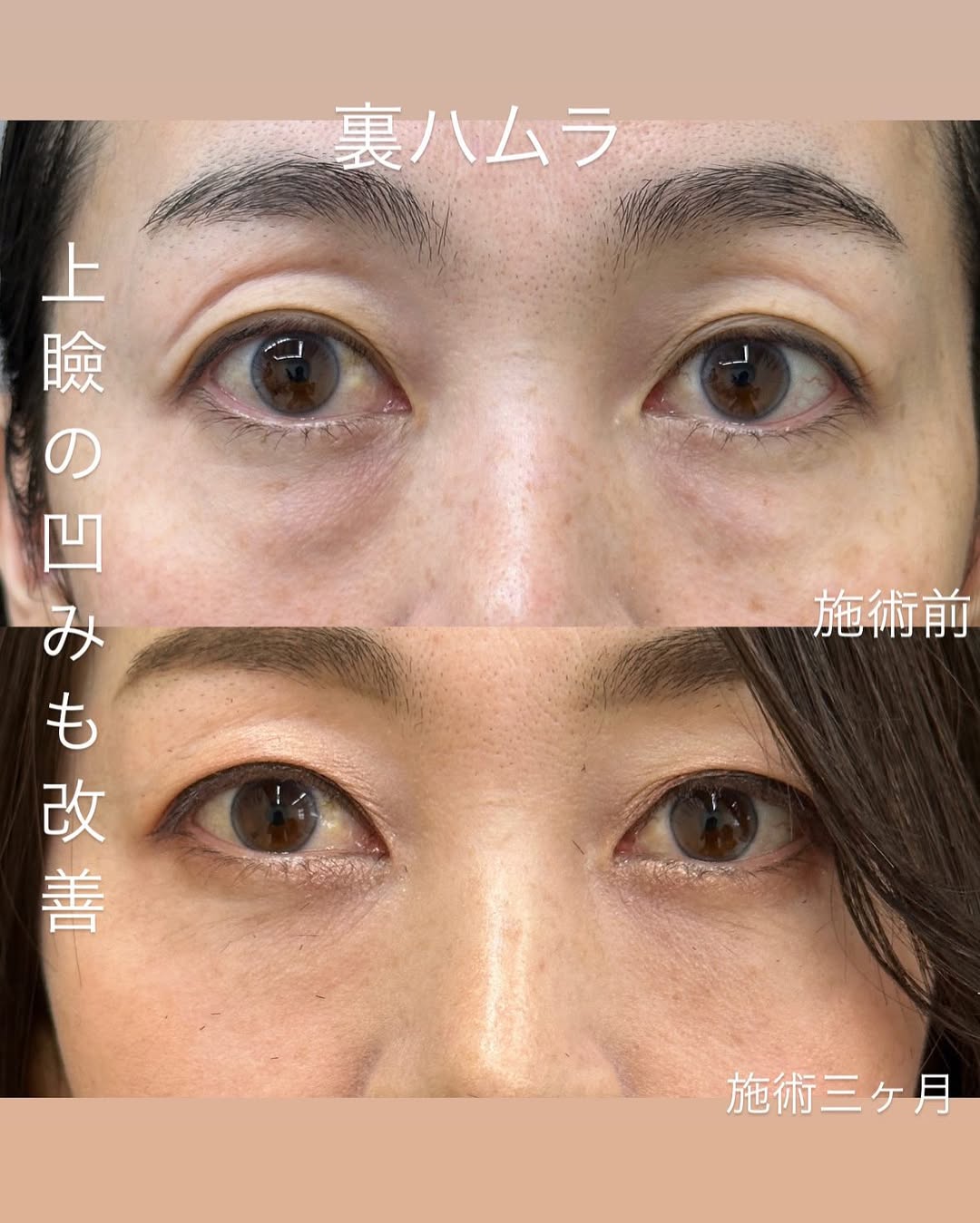 上瞼の凹みを改善のメイン画像