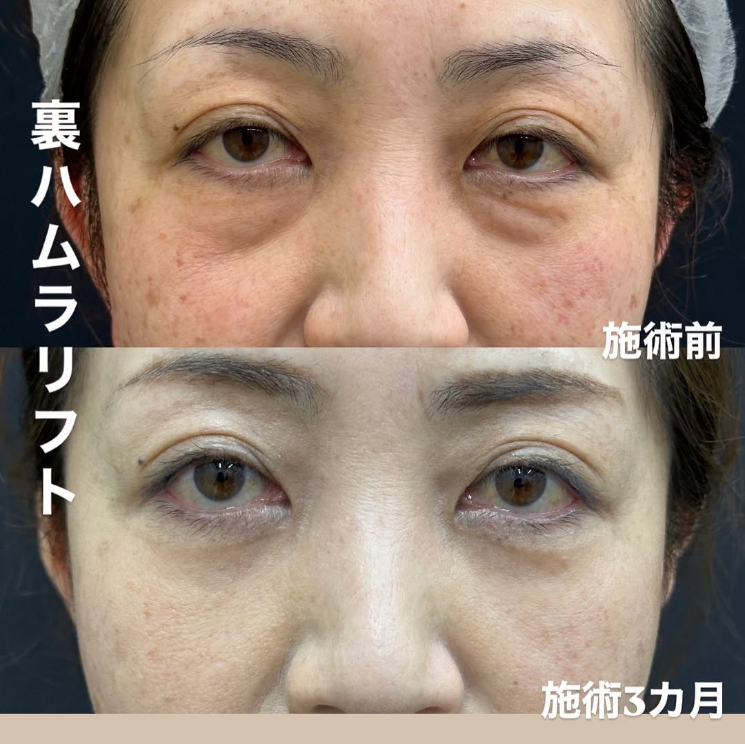 裏ハムラ＋ミッドフェイスリフトのメイン画像