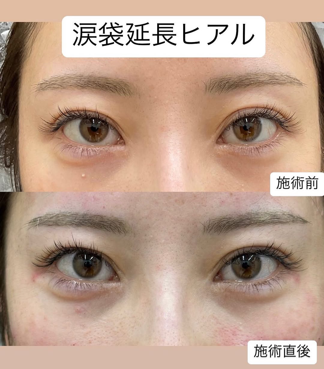 涙袋ヒアル