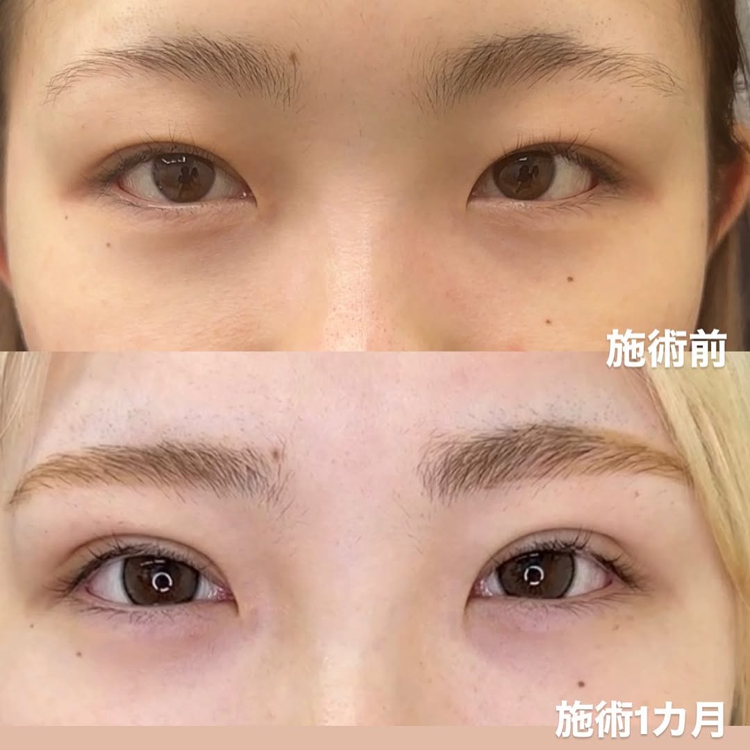 強度重視の埋没法シークレットmトリプルのメイン画像