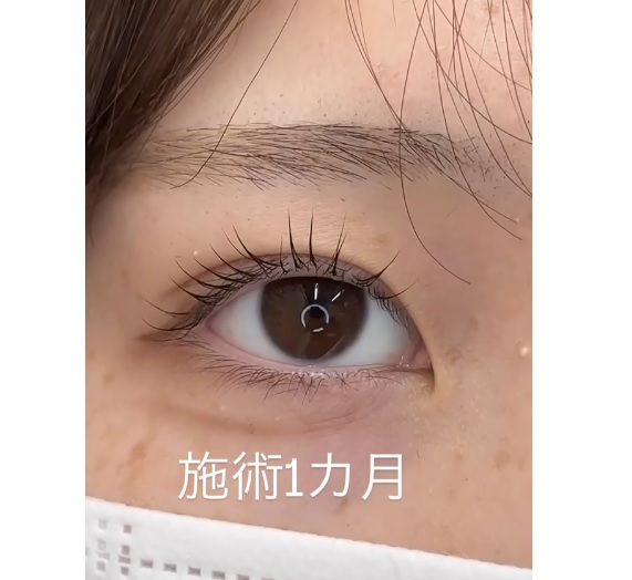 埋没法症例 シークレットMダブルのメイン画像