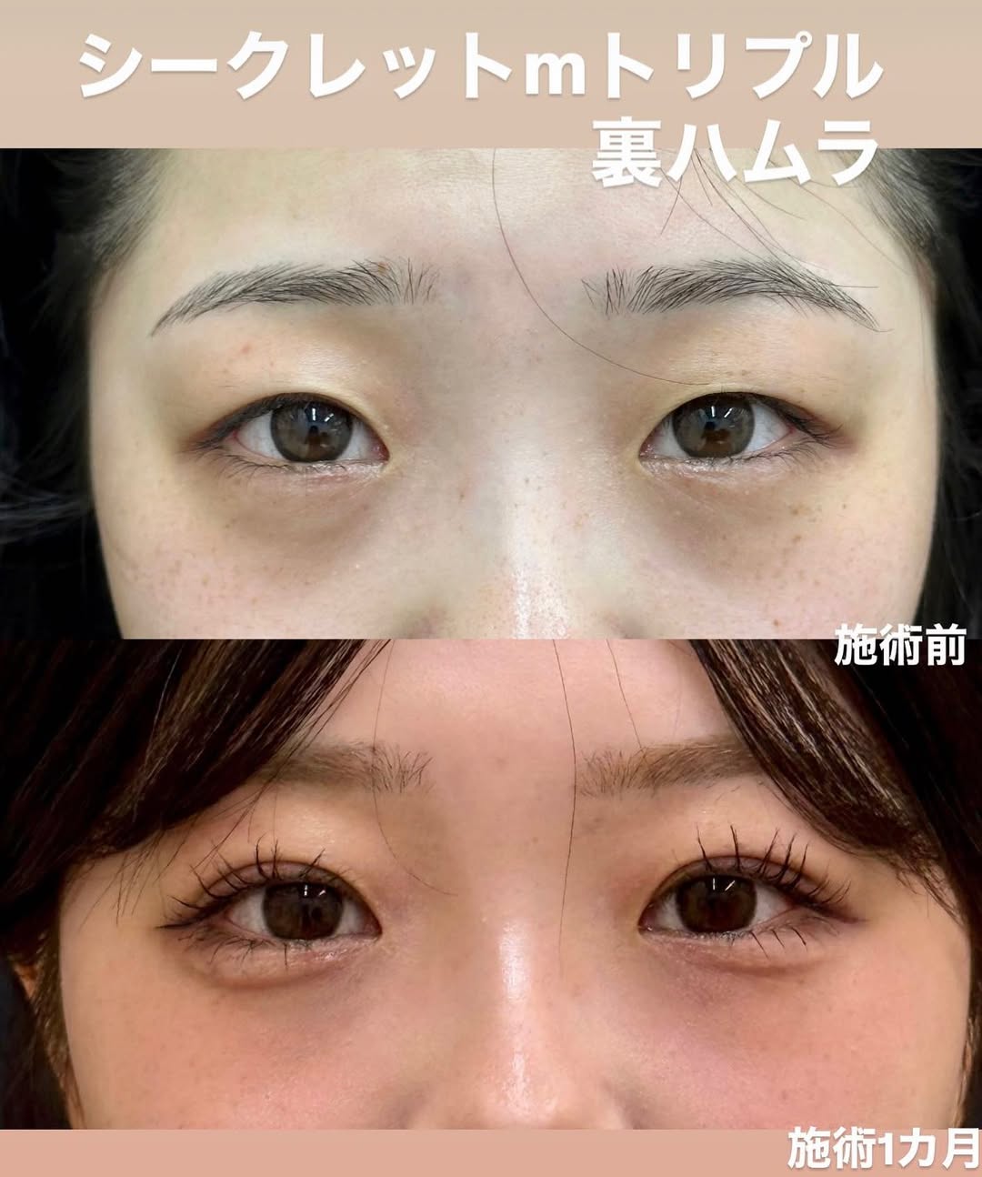 埋没法、裏ハムラ法
