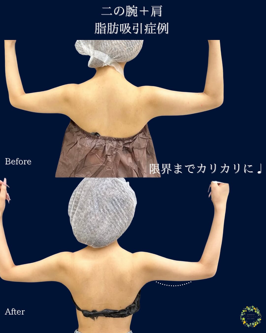 二の腕＋肩