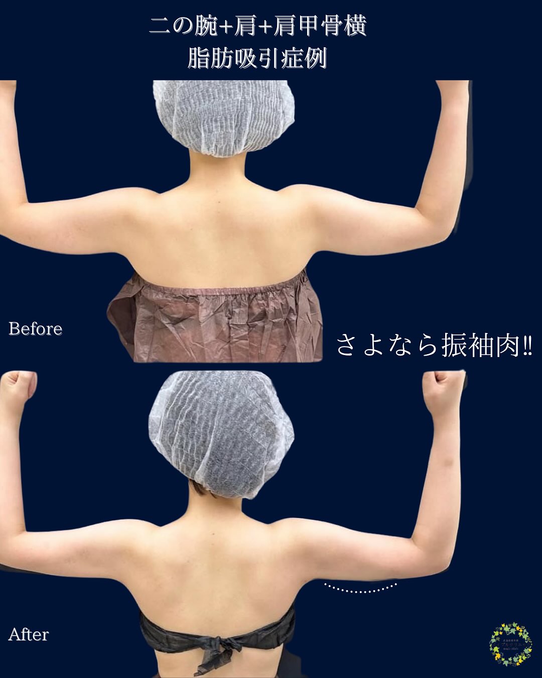 肩甲骨横