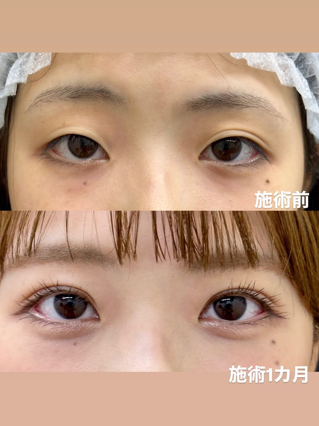 二重整形 埋没法のメイン画像
