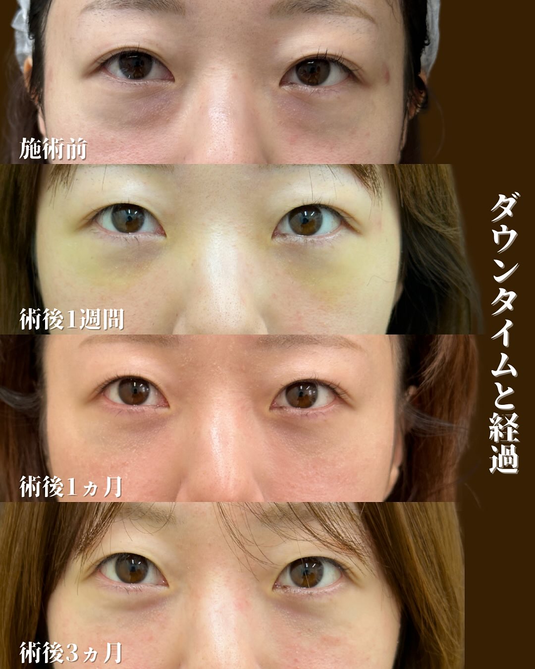 裏ハムラ法