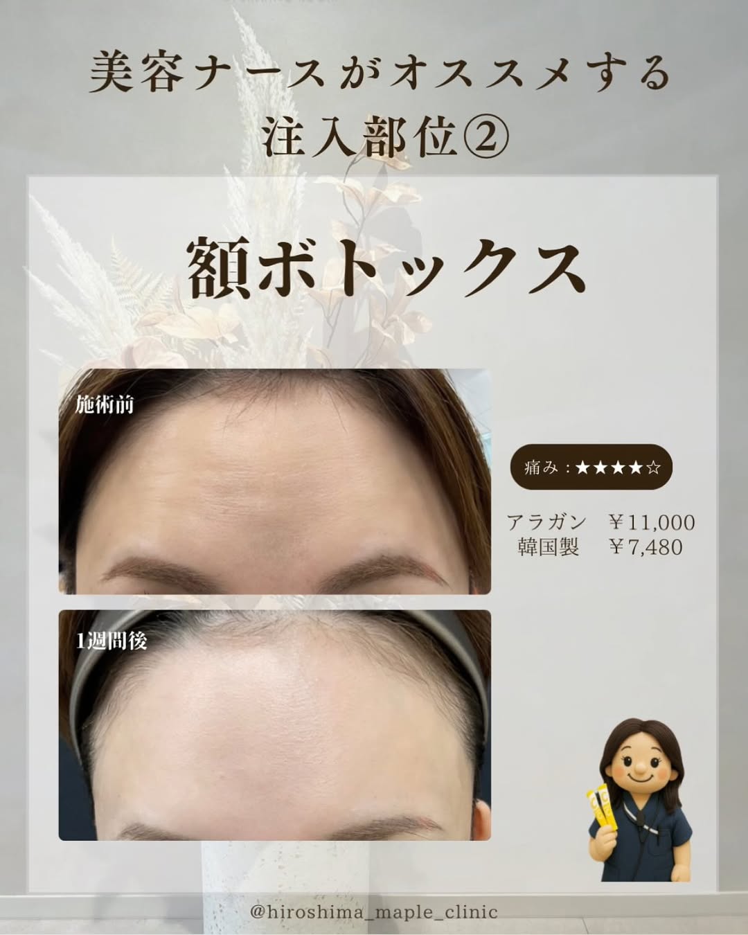 額ボトックス