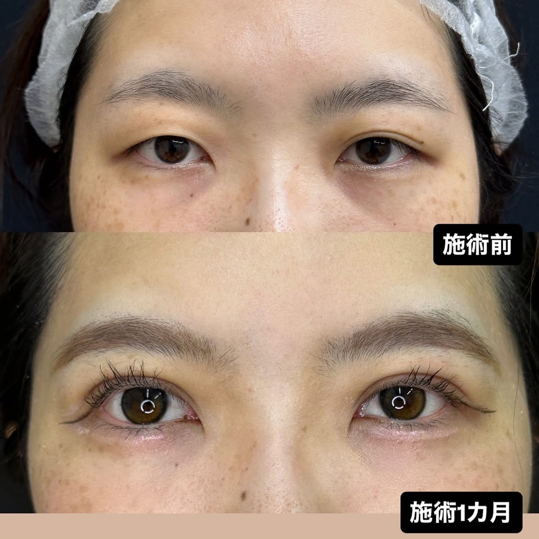 二重整形埋没法の症例のメイン画像