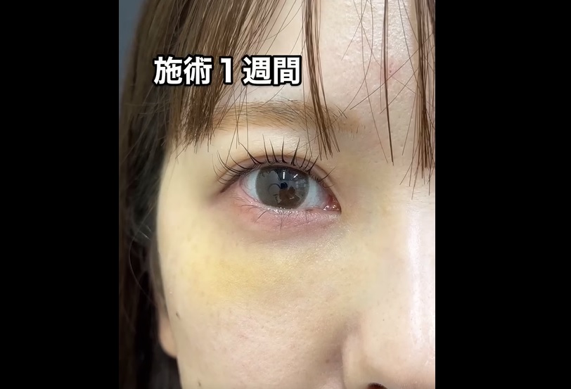 クマ取り治療のメイン画像