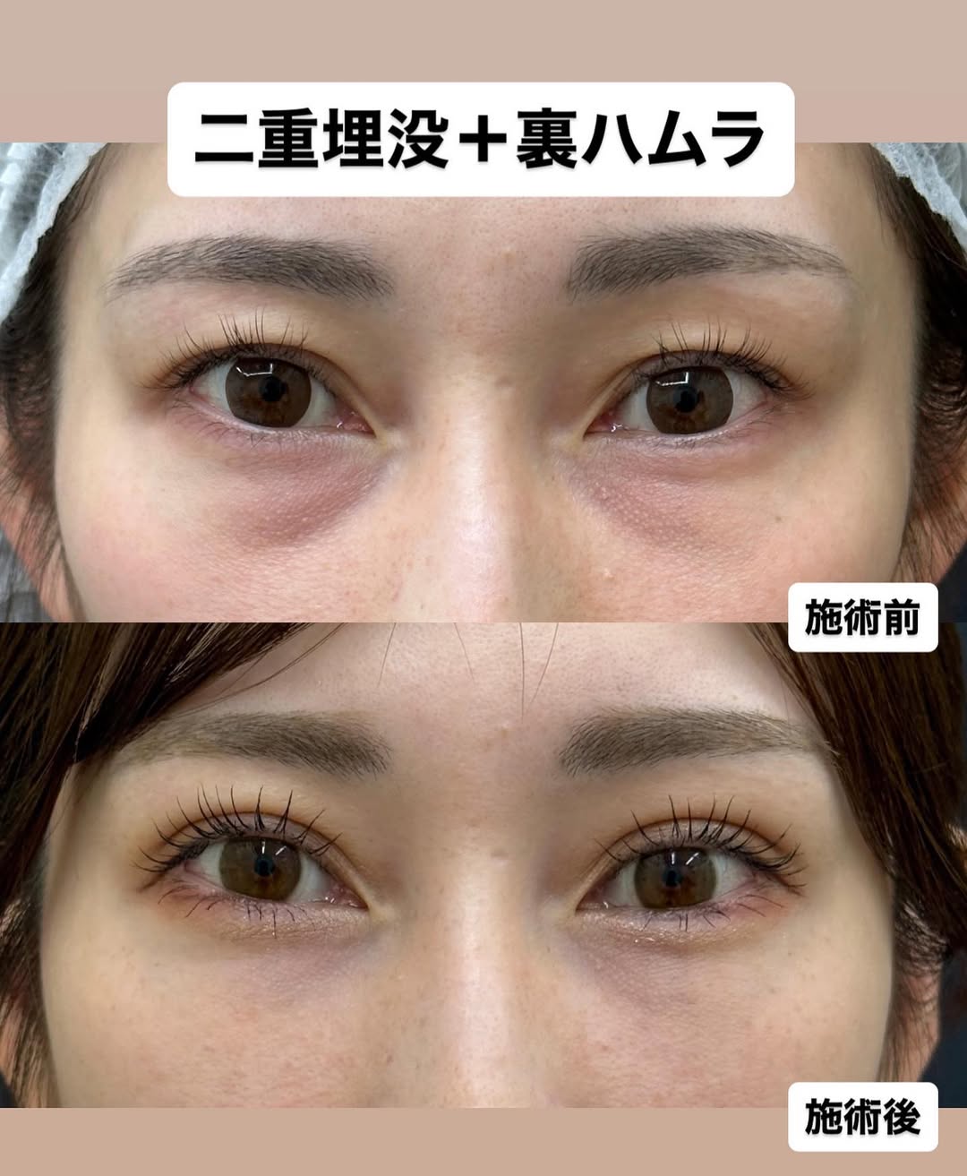 二重整形＋クマ取りのメイン画像
