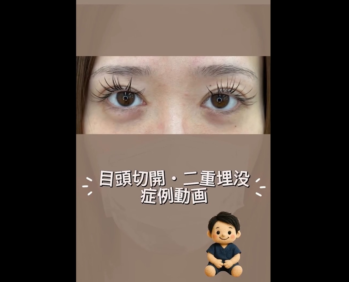 二重整形＋目頭切開のメイン画像