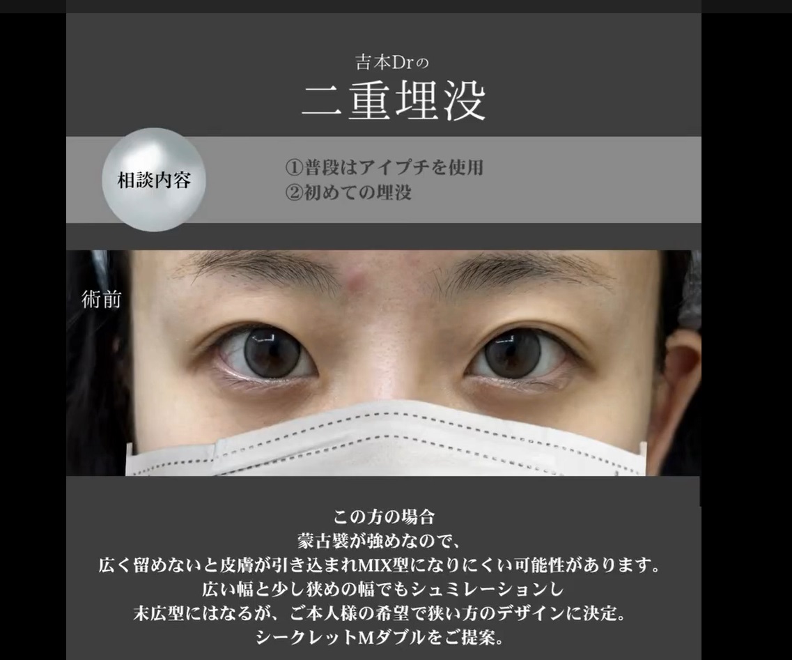 Dr吉本の二重整形(埋没法)症例集のメイン画像