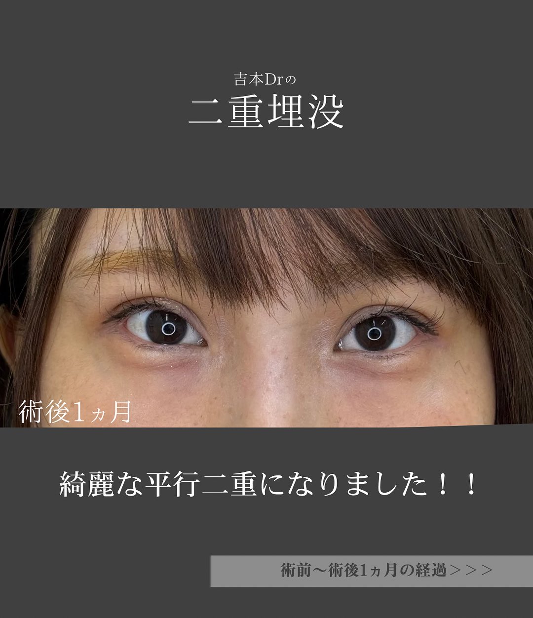 平行二重