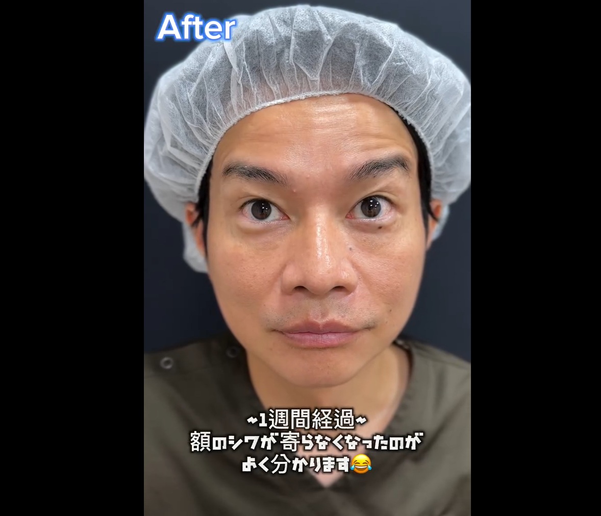 セルフボトックスのメイン画像