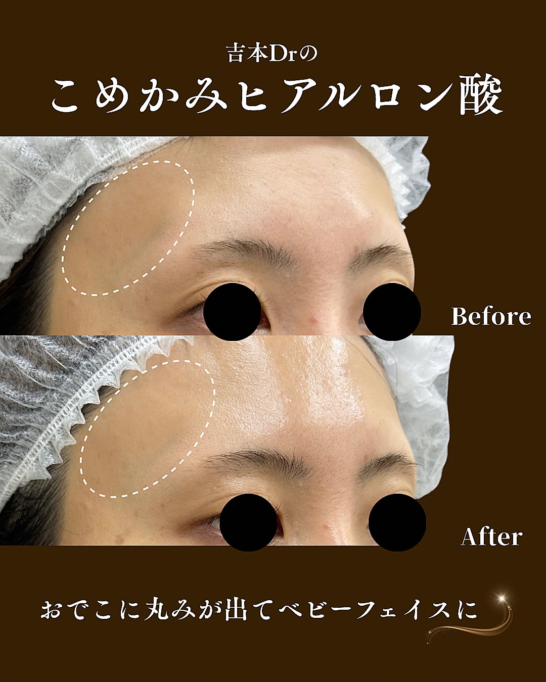 ヒアルロン酸注入