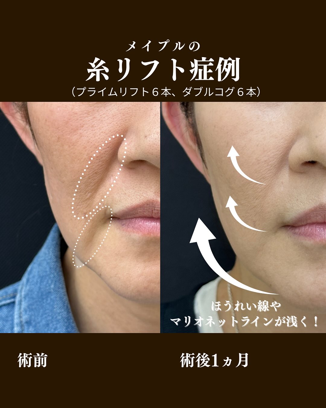 糸リフト症例