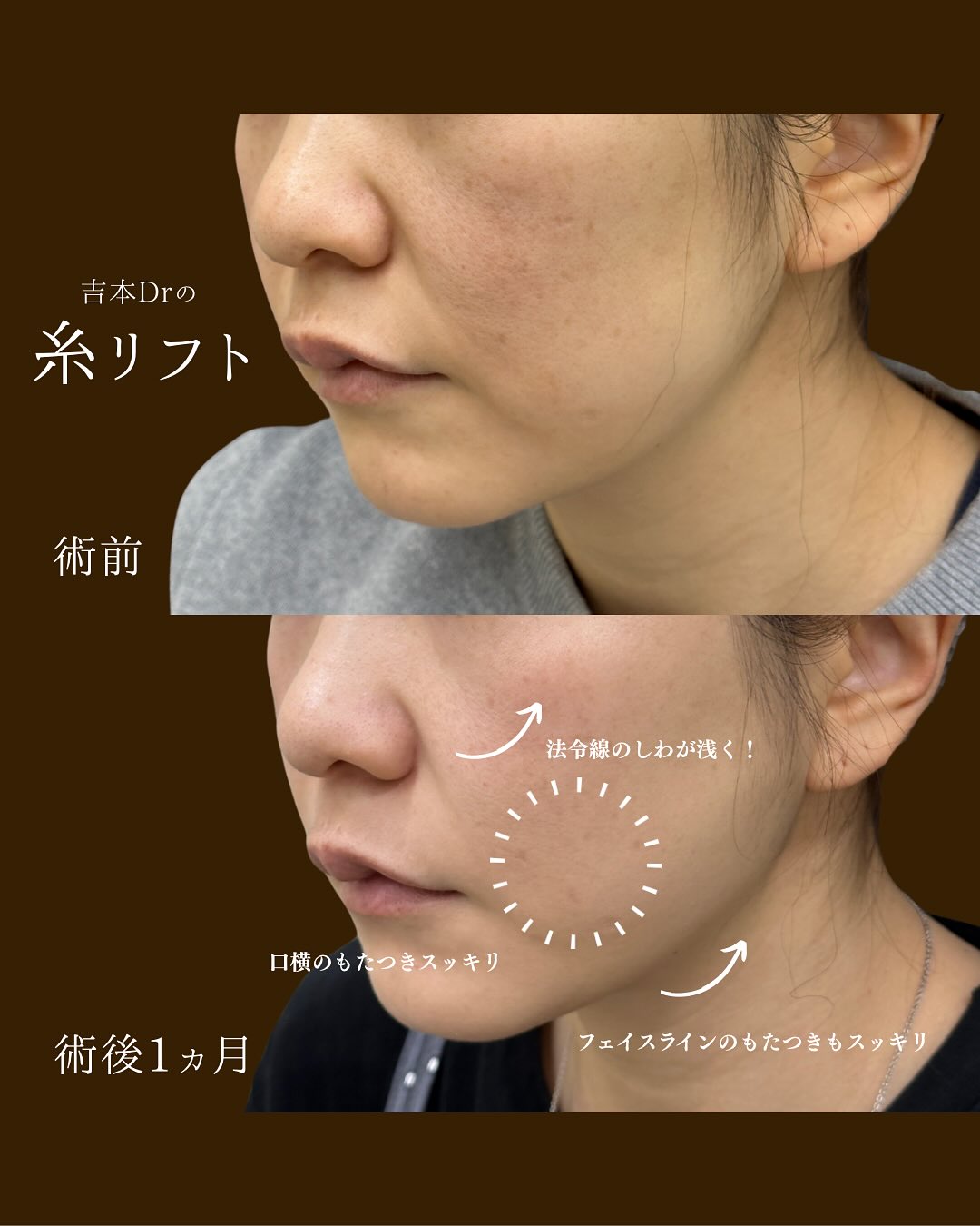 糸リフト