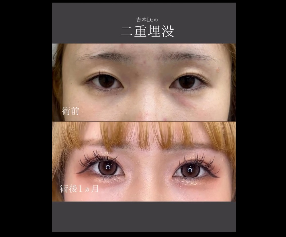 強度重視の埋没法のメイン画像