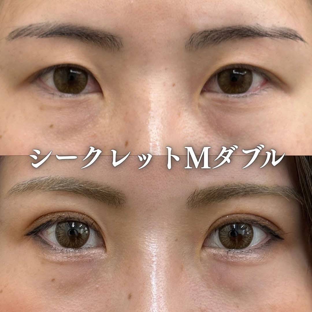 症例：二重整形埋没法のメイン画像