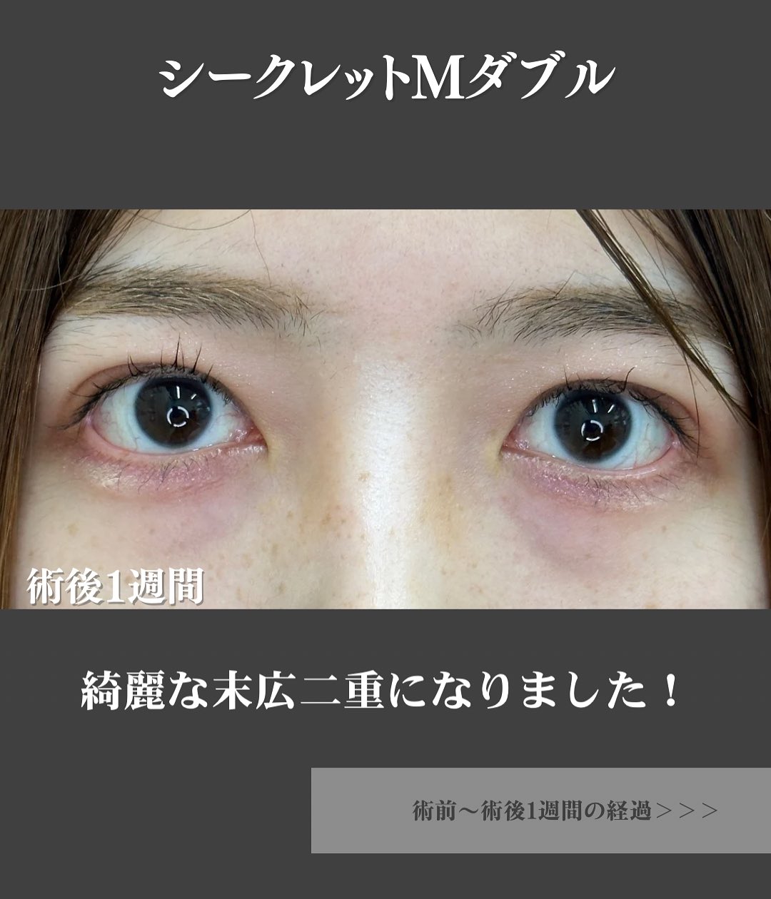 埋没法症例