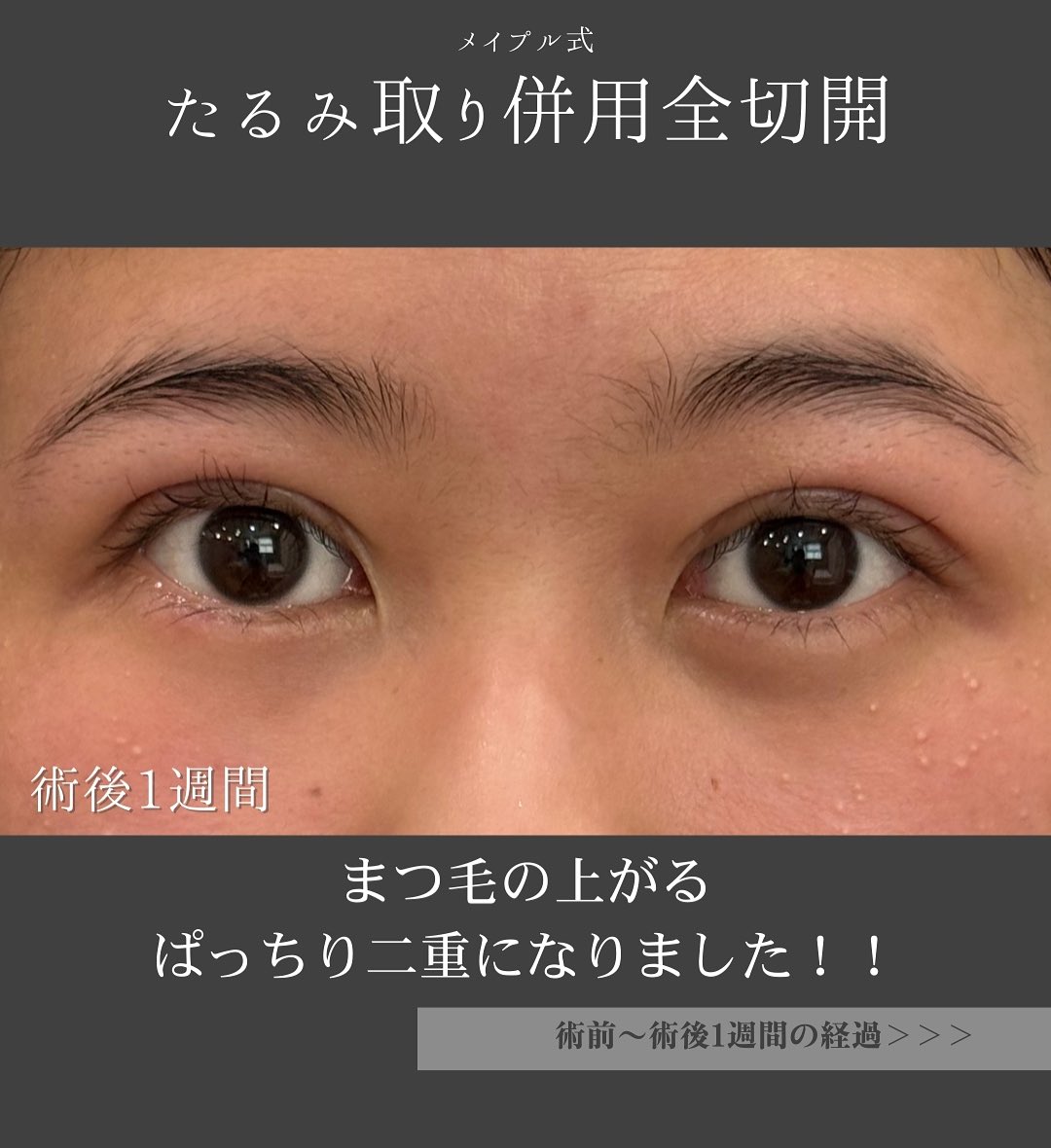 切開法症例