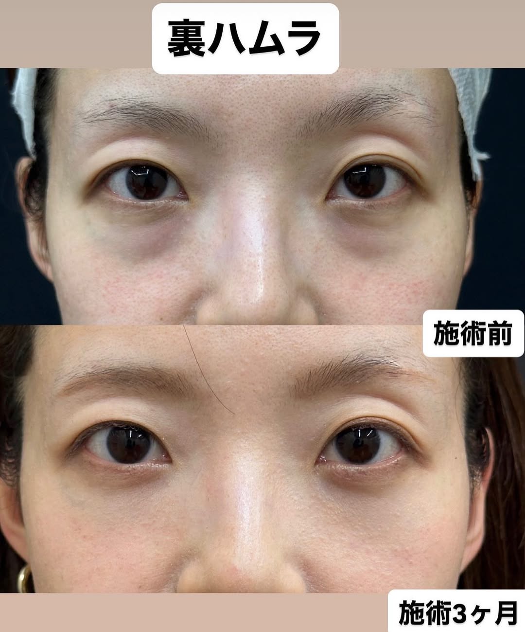 クマ取り治療の症例のメイン画像