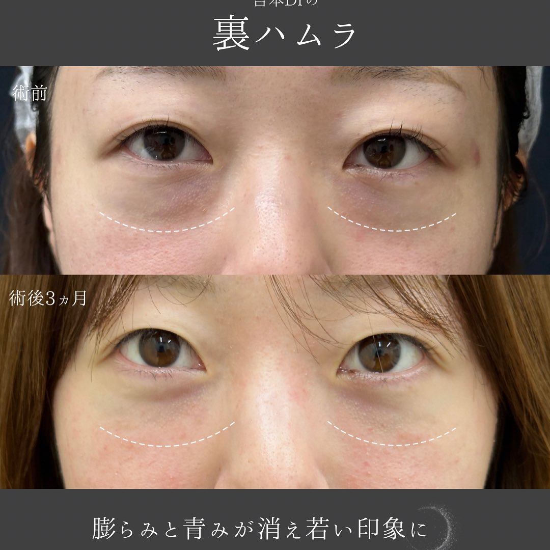 裏ハムラ法