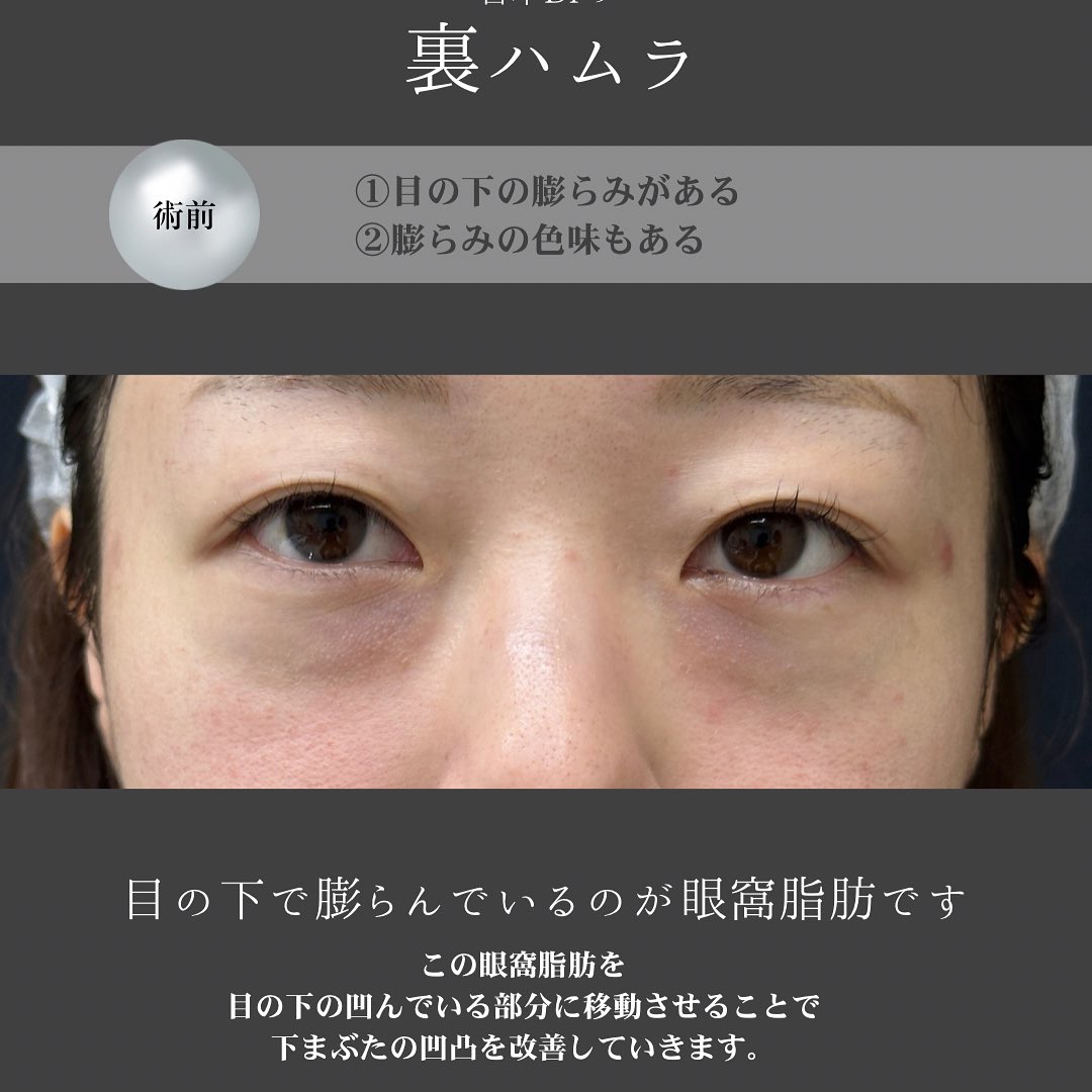 クマ取り治療