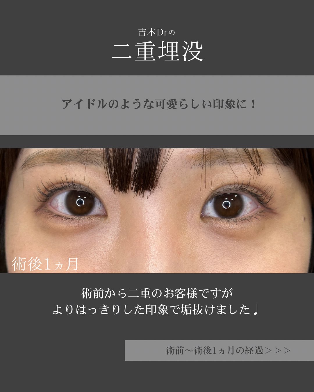 二重埋没法