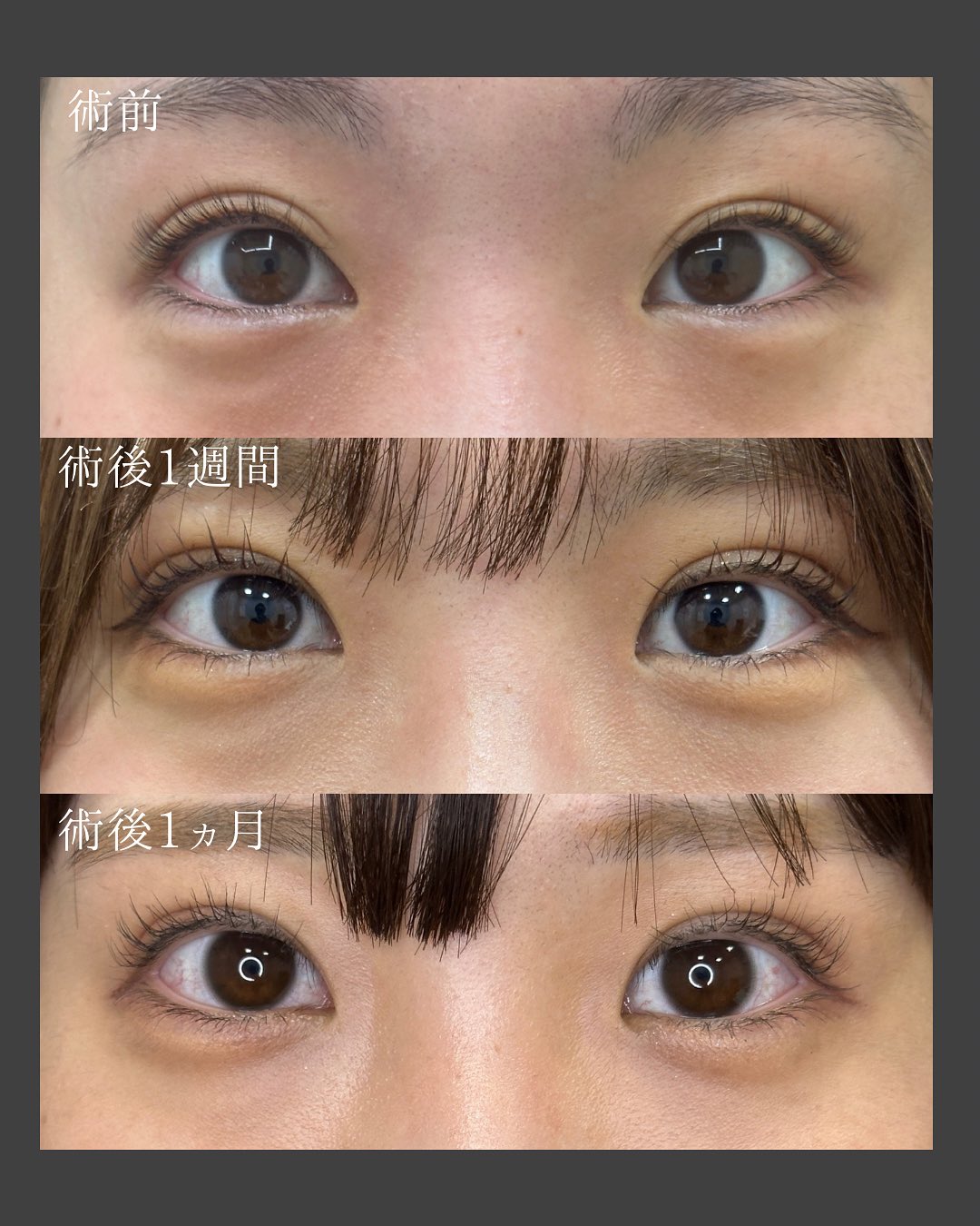 埋没法術後経過
